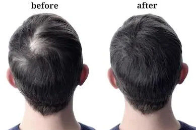 38304-91-5 Hair Loss Powder 99% Minoxidil Ru58841 Powder  Antihypertensive